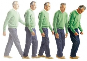 ATENȚIE! Psoriazisul crește riscul dezvoltării bolii Parkinson