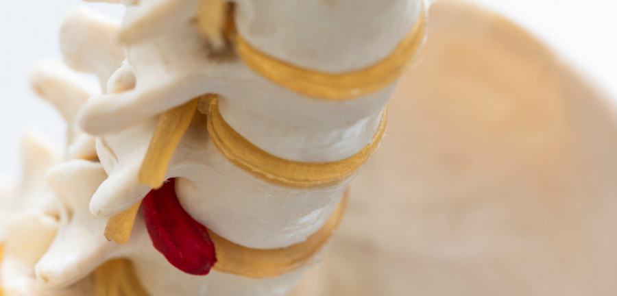 Cum se schimbă calitatea vieții când hernia de disc nu este tratată?