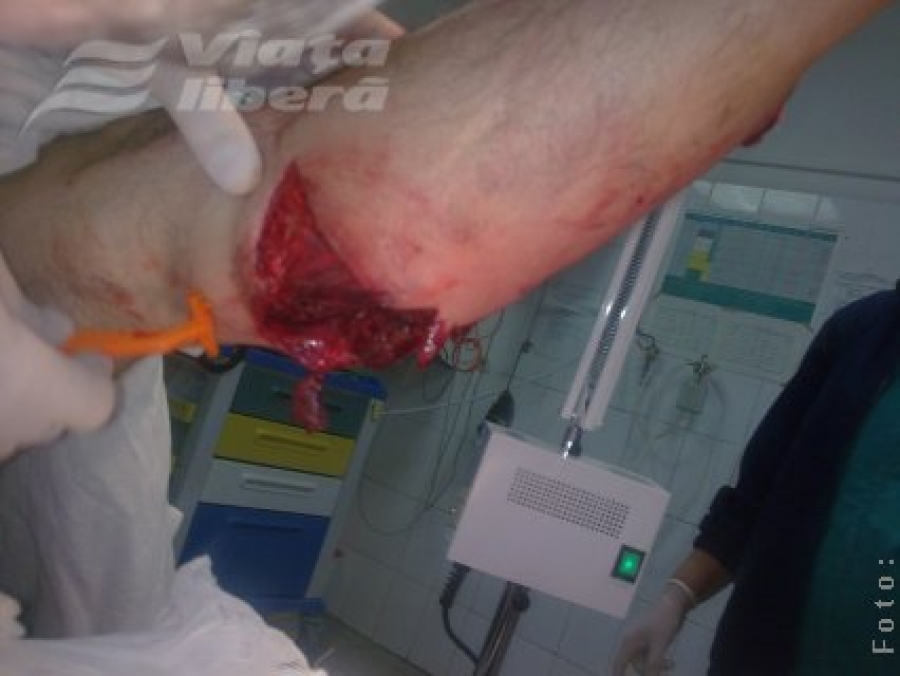 Picior sfâşiat în explozia unui glonţ