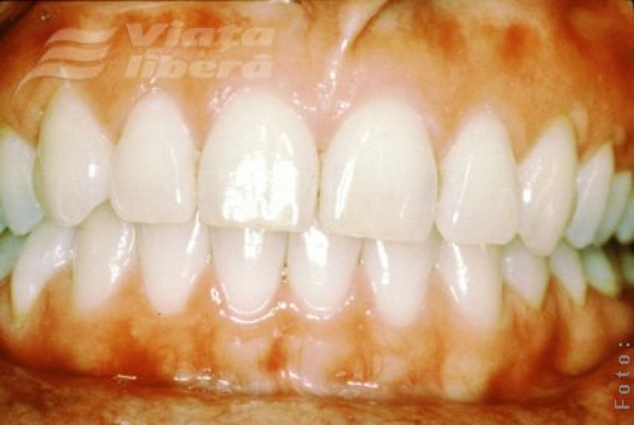 Boala gingiilor
