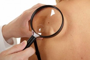 Cum depistăm cancerul de piele. Cinci semne care ar trebui să ne alarmeze