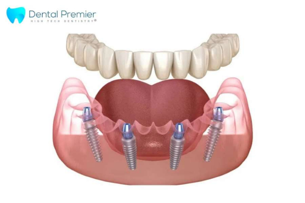 Restaurarea danturii la Dental Premier în București: tehnica de implant ...