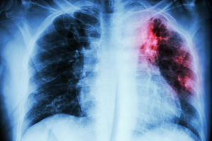 Dr. Marta Lefter, medic pneumolog, avertizează: Tuberculoza este o boală care nu alege