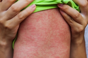 Dr. Mihaela Ganea, medic infecţionist: &quot;VACCINAREA este singura metodă de prevenire a rujeolei&quot;