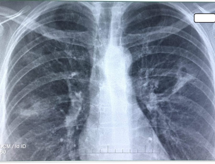 Mai puţine cazuri de TBC la Galaţi, dar forme mai severe. 243 de bolnavi anul trecut, din care 11 copii