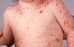 În pragul unei epidemii/ Clase întregi de elevi afectate de vărsatul de vânt