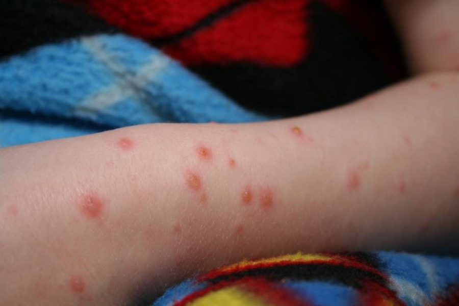 Zeci de copii cu rujeolă, după ce părinţii au refuzat vaccinarea