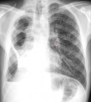 Tuberculoza, cazuri mai puţine, dar mai greu de tratat