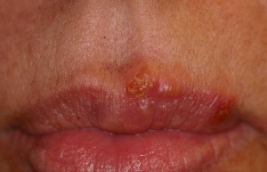 Doi din trei oameni până în 50 de ani suferă de herpes, atenţionează Organizaţia Mondială a Sănătăţii