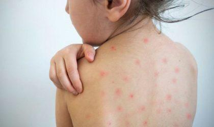 Încă 35 de cazuri de rujeolă