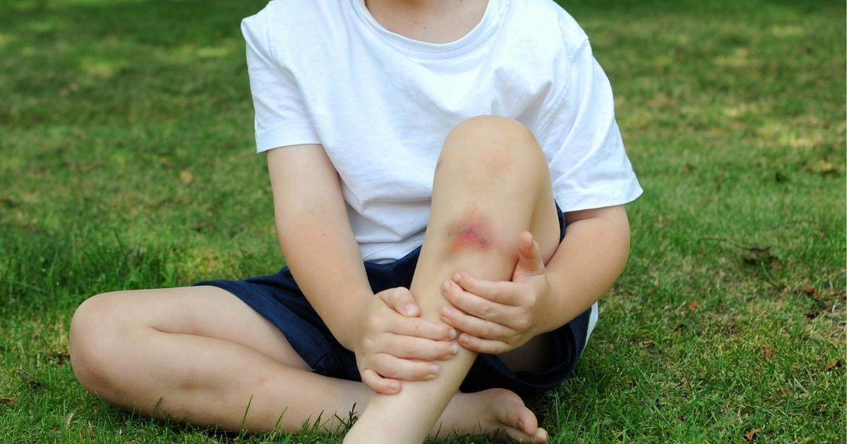 Scapă de vânătai în timp record! Remedii la îndemână