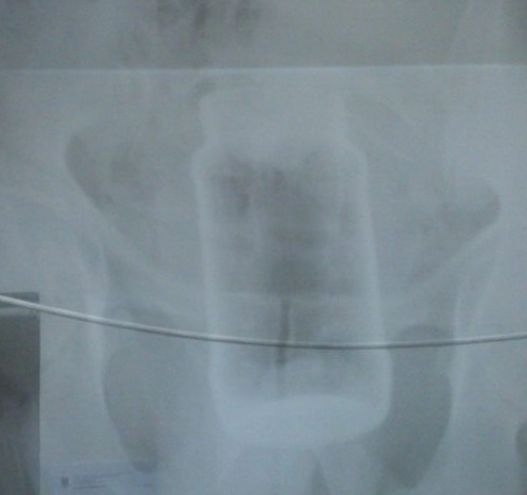 Un gălăţean şi-a introdus un borcan în anus. Vezi ce explicaţie a avut bărbatul 