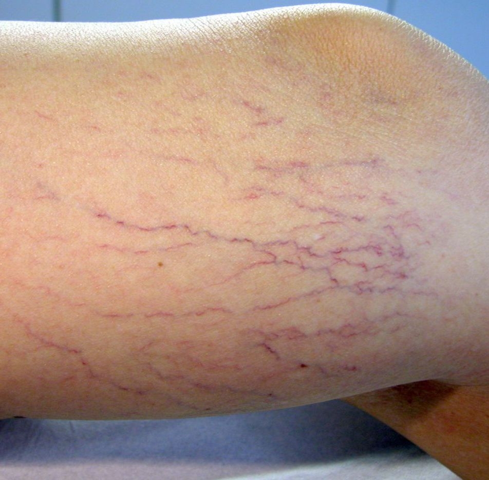 Cum pot fi PREVENITE varicele şi capilarele sparte