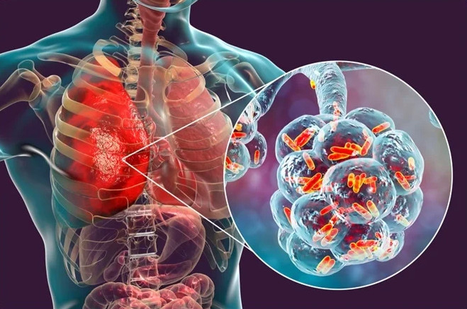 În ultima săptămână, peste 1.900 de cazuri de viroze și pneumonii, la Galaţi