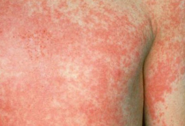 UPDATE. DSP Galați confirmă apariția mai multor cazuri de scarlatină