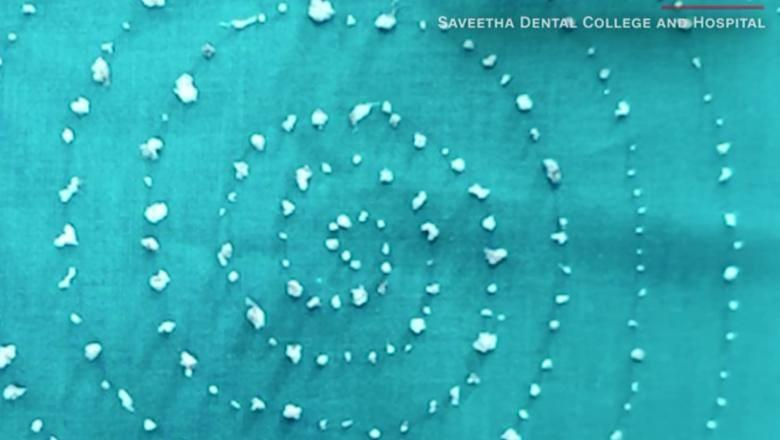 Unui copil i-au crescut 526 de ”dinți”