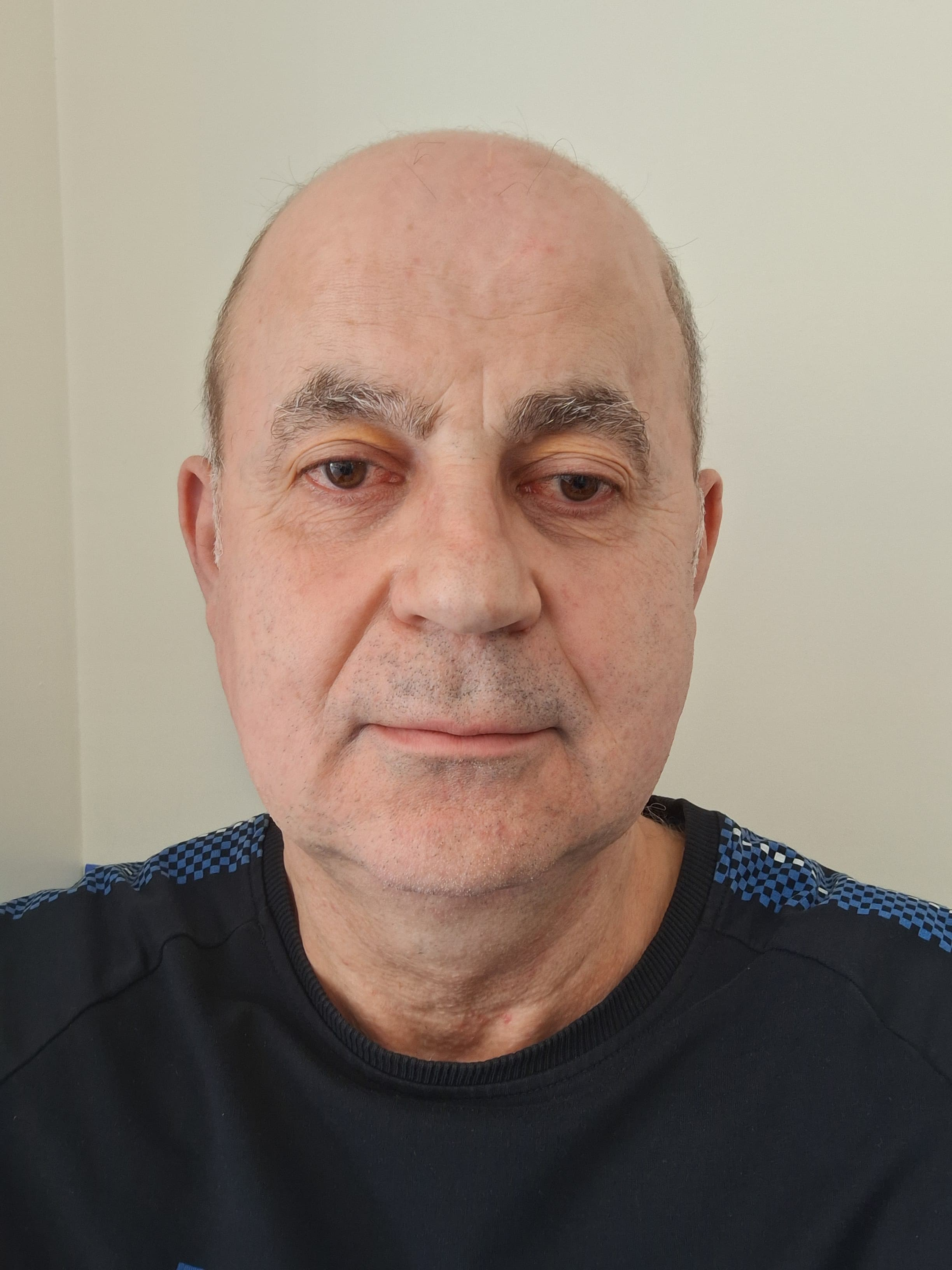 Un gălățean are nevoie de bani pentru a patra operație la cap