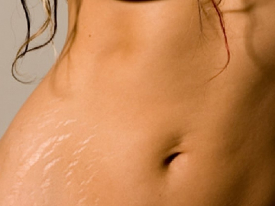 Vergeturile, o problemă medicală cu influenţe psihologice