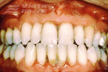 Sângerarea gingiilor - un semnal de alarmă