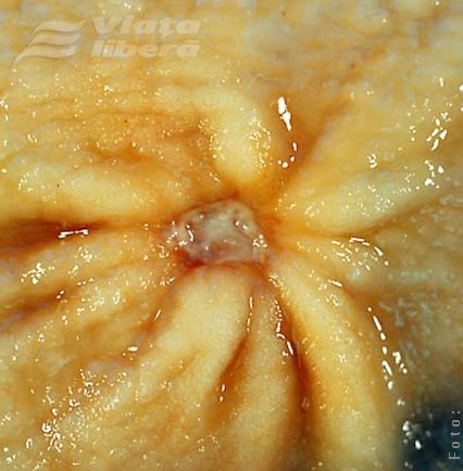 Boli de sezon - Ulcerul gastric