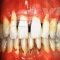 Sângerarea gingiilor – un motiv de alergat la stomatolog