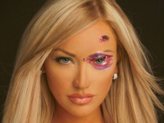 Publicitate cu vânătăi şi alte înţepături  