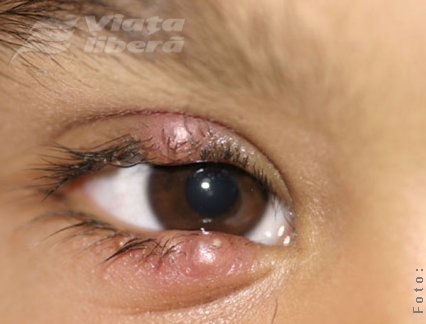 Tratament pentru ulcior