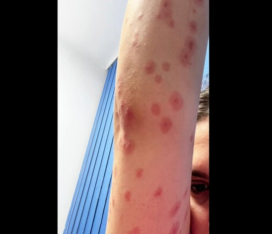 Studentă din Regie, la spital cu zeci de mușcături de ploșnițe