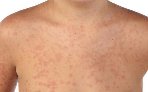 Închiderea școlilor a redus cazurile de rujeolă