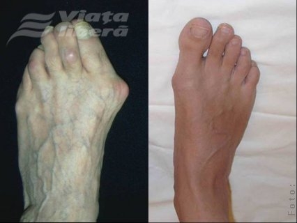 Tratamentul monturilor