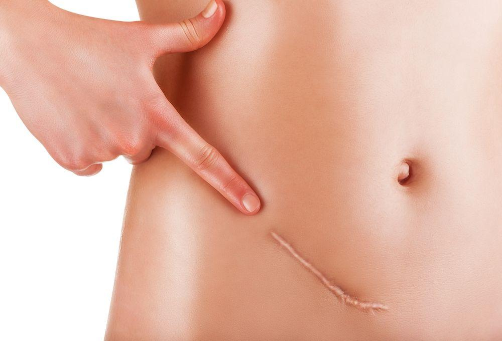 Remediu natural pentru cicatrici