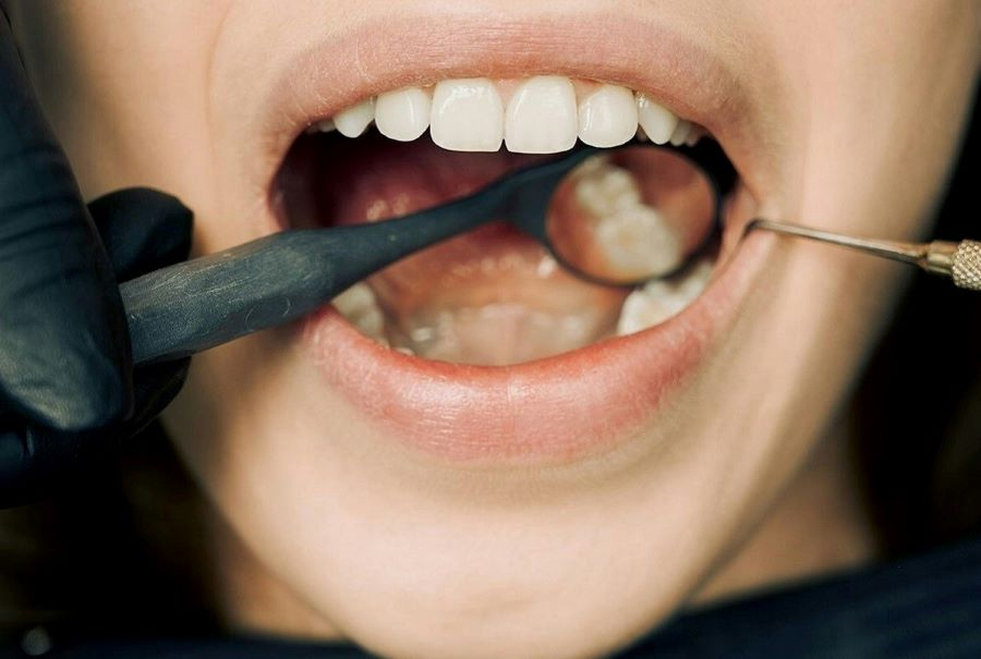 Ce este o coroană dentară și ce rol are ea în recuperarea stării dinților?