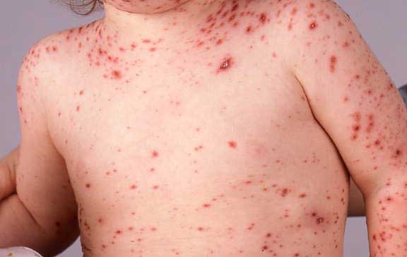 În pragul unei epidemii/ Clase întregi de elevi afectate de vărsatul de vânt