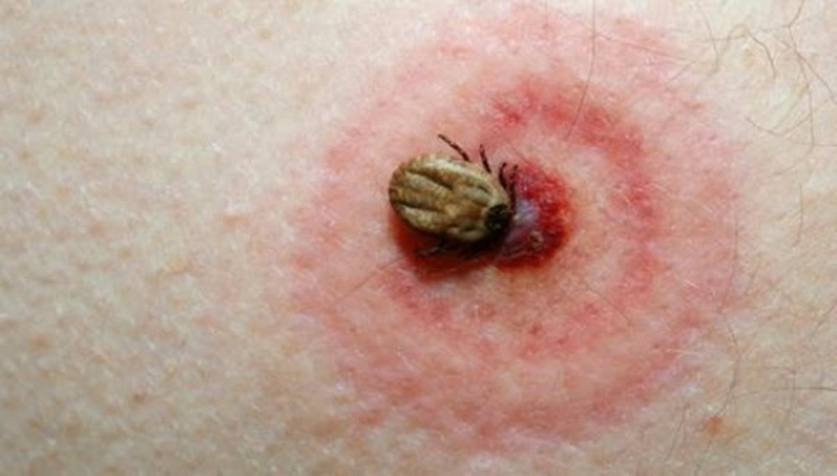 Ce trebuie să faci dacă te muşcă o căpuşă